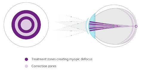 How MiSight lenses work
